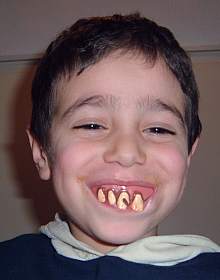 Giovanni trägt falsche Zähne